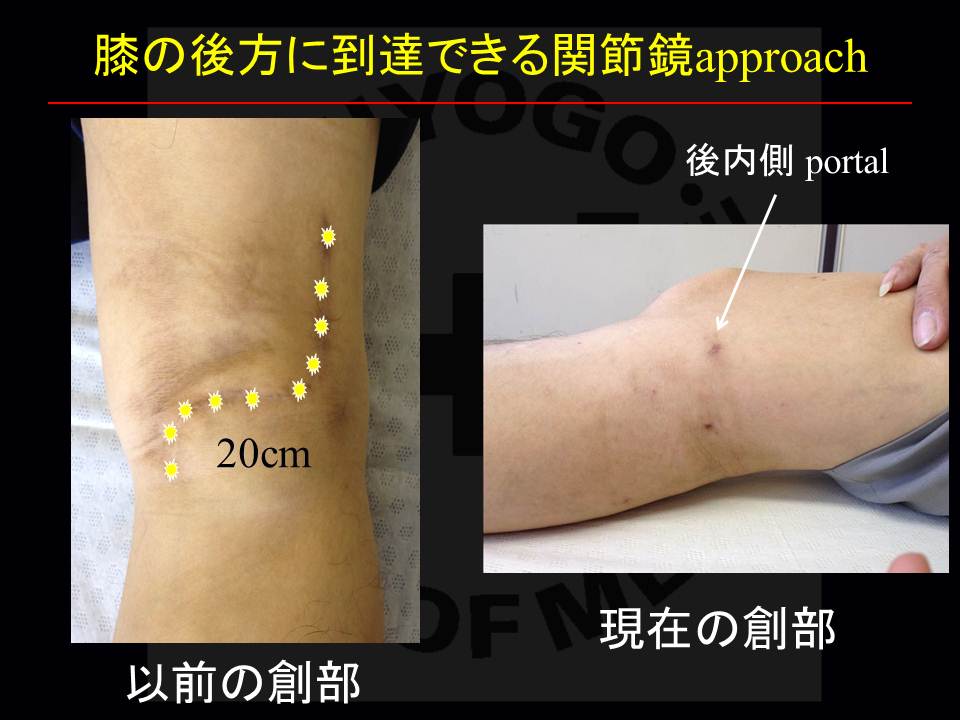 12月17日兵庫医大フロンティアセミナー 膝関節鏡外科医のblog