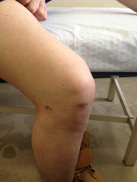 大きく切開する手術は嫌ですよね 膝関節ガングリオンに対する関節鏡手術 Trans Septal Approach 膝関節鏡外科医のblog