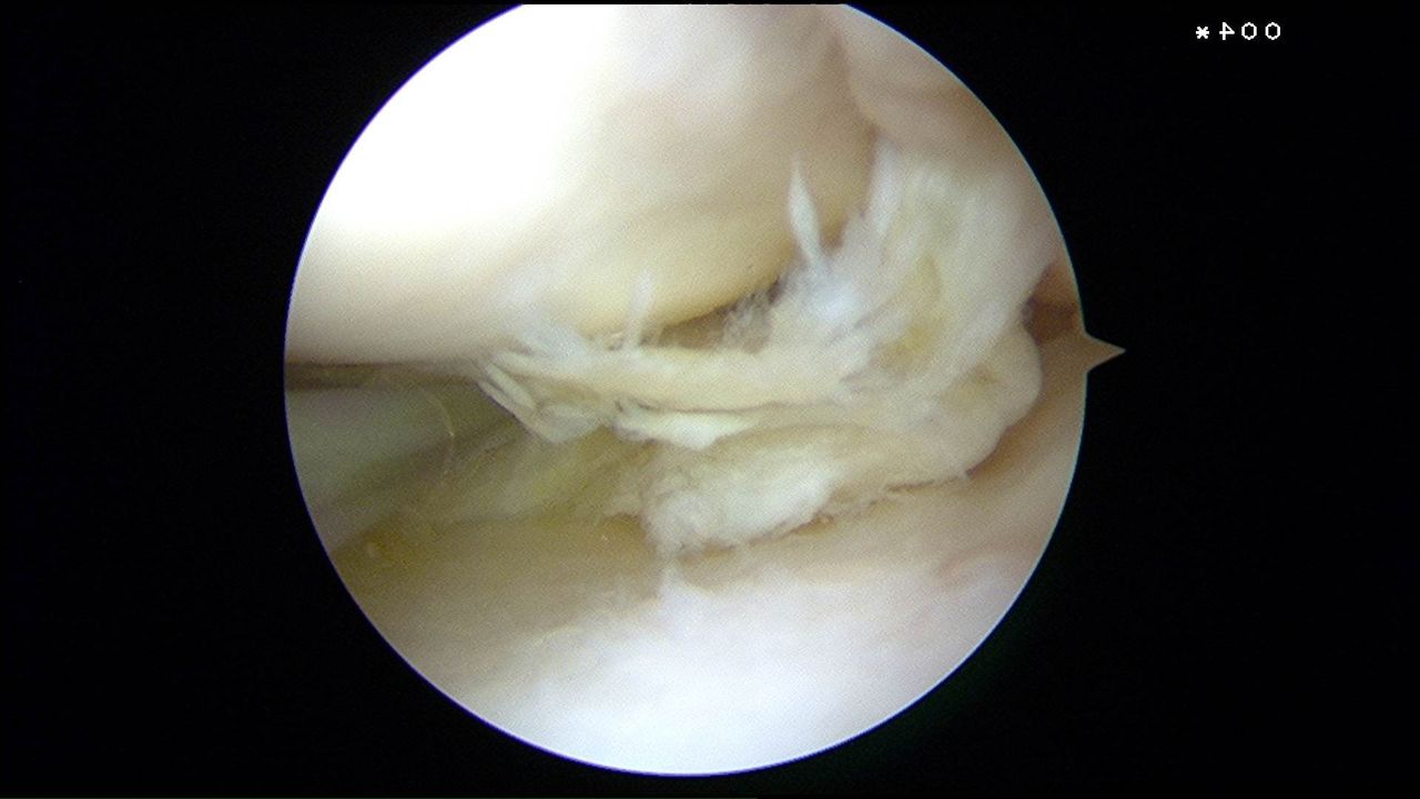 半月板損傷に対する縫合術 膝関節鏡外科医のblog