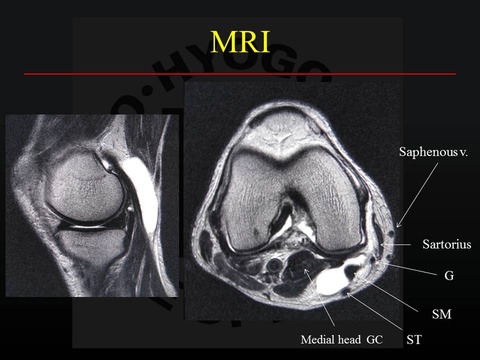 山下孝　poplyteal cyst1