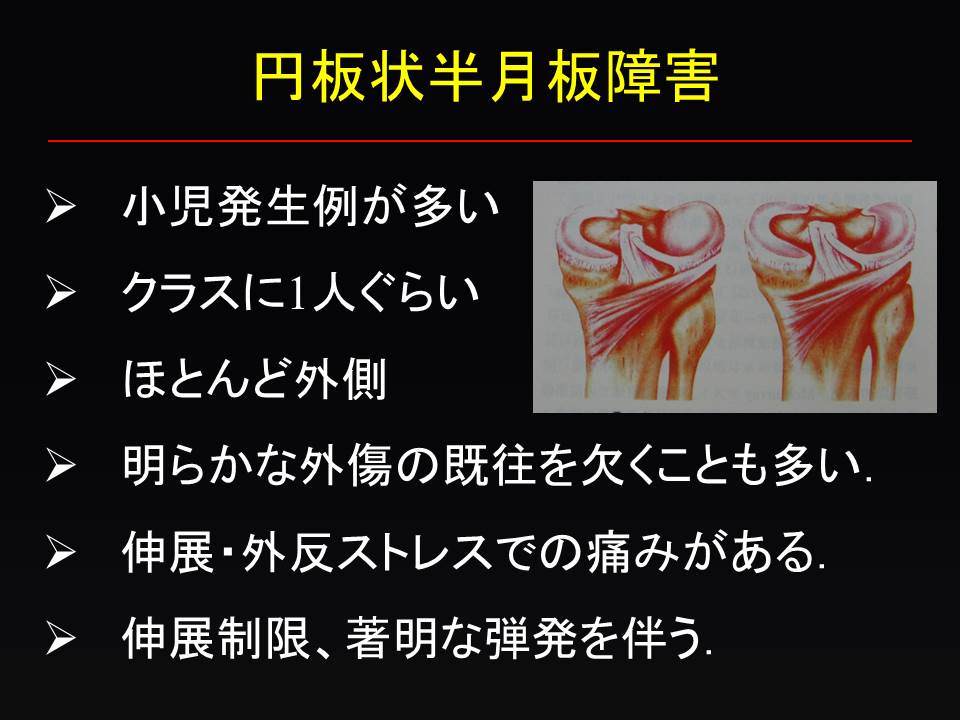 円板状半月板損傷に対する温存縫合術 膝関節鏡外科医のblog