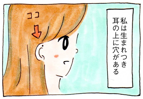 【先天性耳瘻孔】富に恵まれるという穴