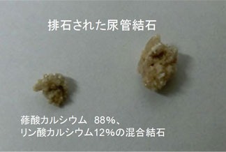結石1