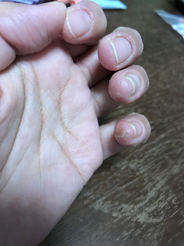 手湿疹 指荒れで皮膚科に行ってきた 手荒れが酷い 肌弱い同盟