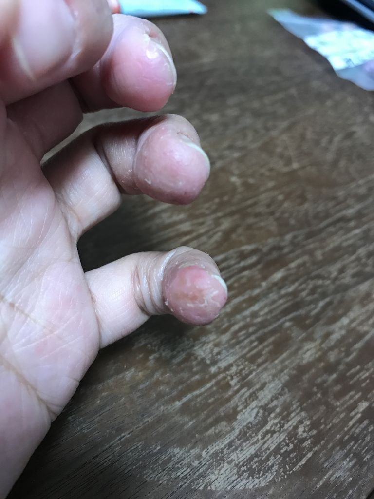 手湿疹 指荒れで皮膚科に行ってきた 手荒れが酷い 肌弱い同盟