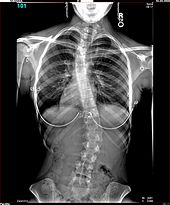 170px-Amanda-Scoliosis