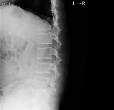 【驚愕】 ヘルニアになったワイ、”ロキソニン”とかいう薬飲んだら一瞬で治ってしまうｗｗｗ