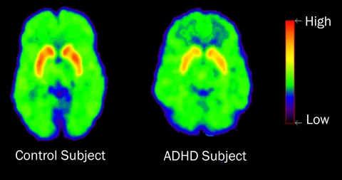 adhd-dat-300