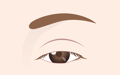 眼瞼下垂の分類2_軽度な下垂の画像