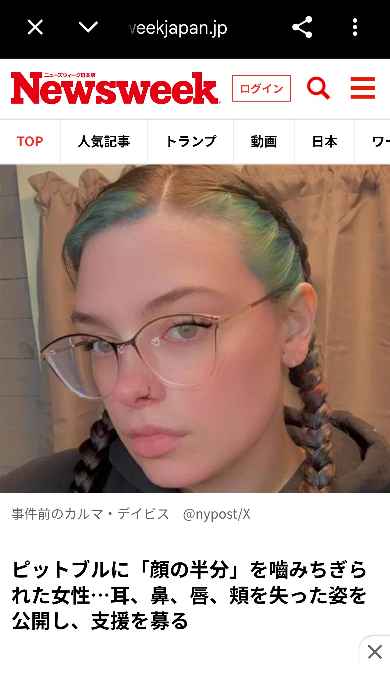 【閲覧注意】てんかん発作で気絶中に飼っていた犬に顔を食べられてしまった女性、現在の顔を公開へ…