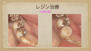 自費ユニット レジン治療.002