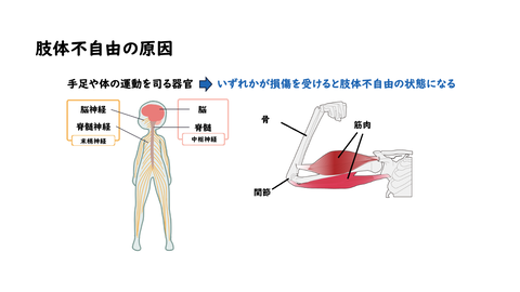 肢体不自由の原因