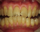 ホワイトニング3－1