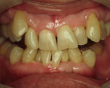 ホワイトニング1－2