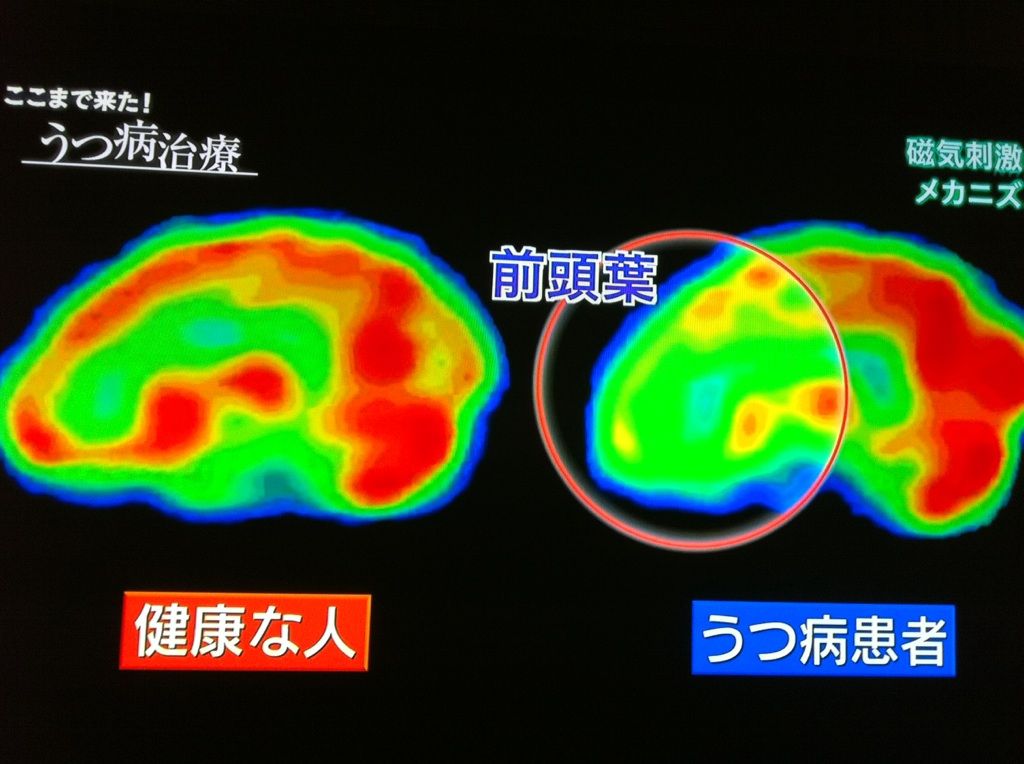 脳科学の進歩に見た うつ病 治療と脳と心の不思議な関係 13年目 I式コーチング 稲田コーチのブログ