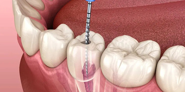 root-canal-north-vancouver-960x480