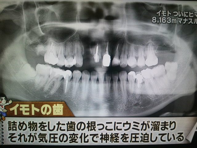 画像 ｲﾓﾄｱﾔｺが体張りすぎた結果がイタ過ぎる 歯が無い理由とは ショ二ッキ