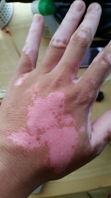 白斑と甲子園の売り子さんと Igataya Blog