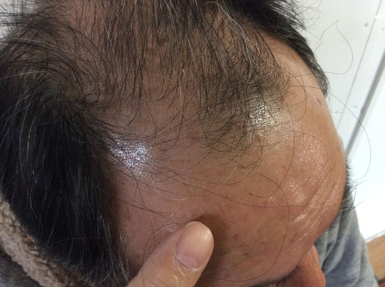 エヴォルプラス 薬用育毛剤 口コミ 体験レビュー