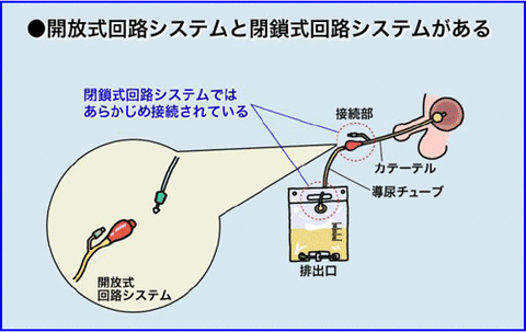 尿・閉鎖式