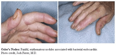 oslersnodes