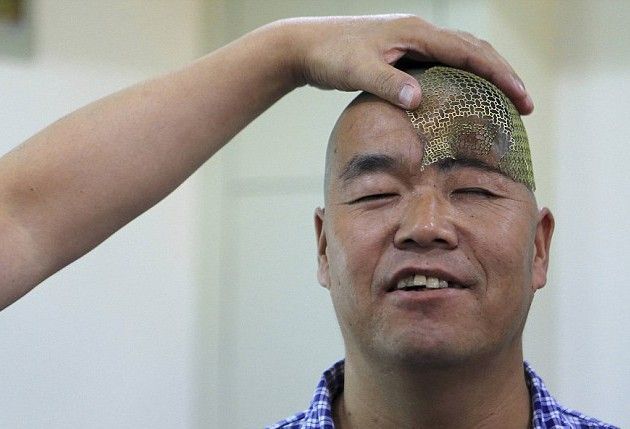 中国 落下事故で頭が凹んだ男性 3dプリンターで復元へ 画像あり まとめサイトビルダーを使ってみた