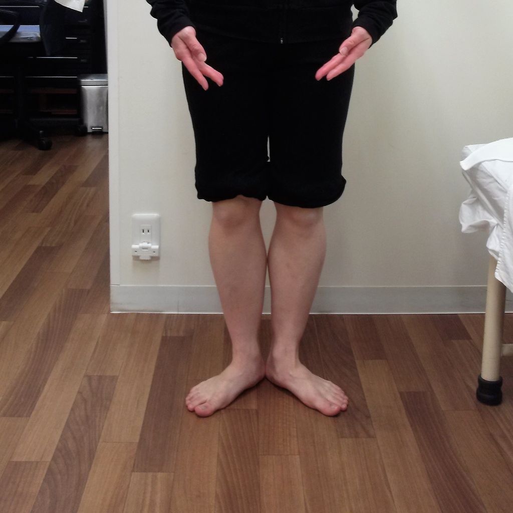 色々な足 44 代前半のバレエ愛好者 偏平足 甲が出ない足 長母趾屈筋腱腱鞘炎 いけちゃんのblog 練馬区関町の池島接骨院 院長日記 バレエ テーピング 足底板など