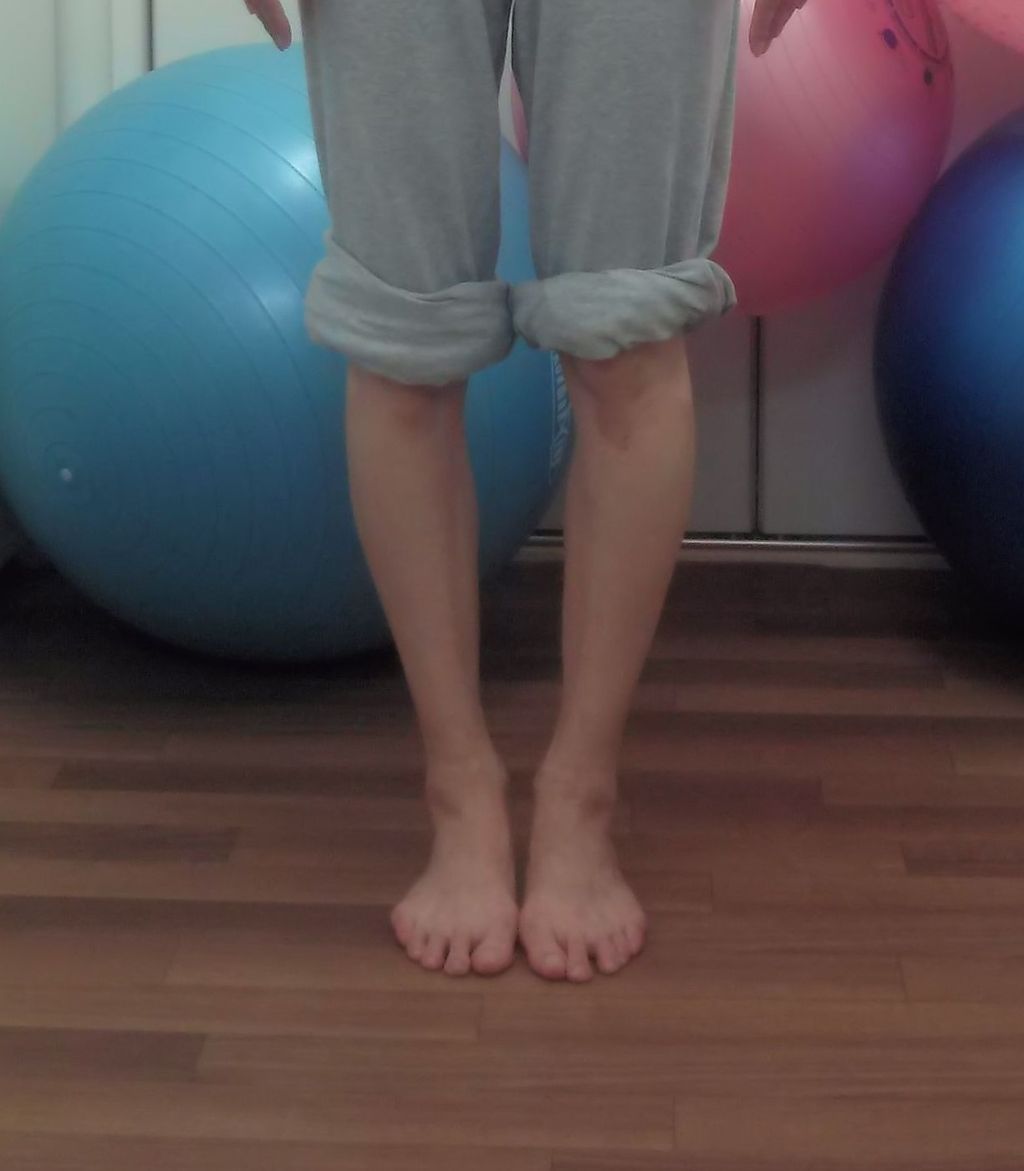 色々な足 56 テーピング勉強会のモデルをしてくれた40代のバレエ指導者 O脚 反張膝 やぶにらみ膝 脛骨外捻 甲が硬い足 いけちゃんのblog 練馬区関町の池島接骨院 院長日記 バレエ テーピング 足底板など