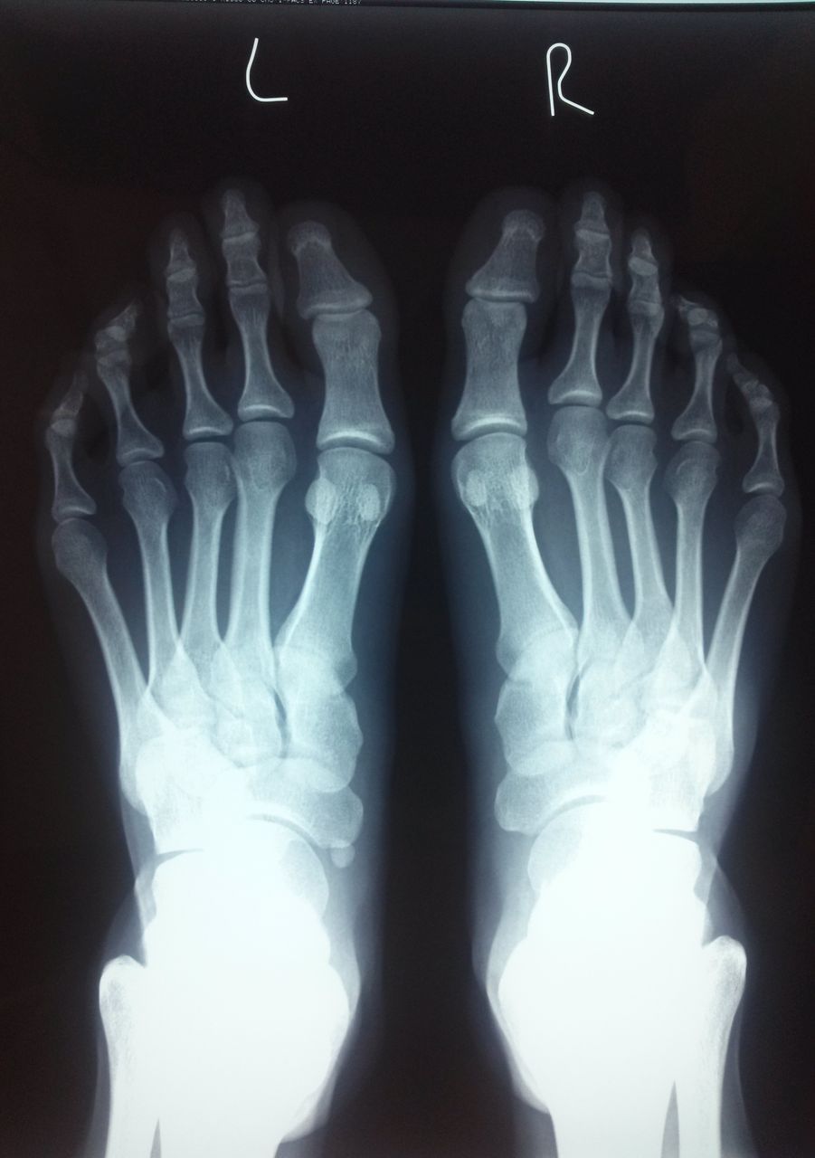 色々な足 13 外脛骨とシンスプリント いけちゃんのblog 練馬区関町の池島接骨院 院長日記 バレエ テーピング 足底板など