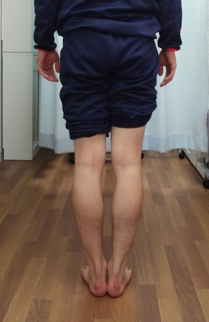 色々な足 42 16歳の野球をしている高校生 O脚 腸脛靭帯炎 いけちゃんのblog 練馬区関町の池島接骨院 院長日記 バレエ テーピング 足底板など 色々な足 42 16歳の野球をしている高校生 O脚 腸脛靭帯炎 いけちゃんのblog 練馬区関町の池島接骨院 院長日記 バレエ テーピング 足底板など