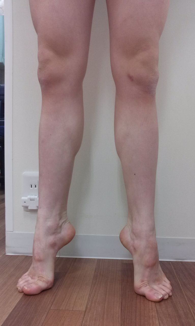 色々な足 9 新体操 いけちゃんのblog 練馬区関町の池島接骨院 院長日記 バレエ テーピング 足底板など