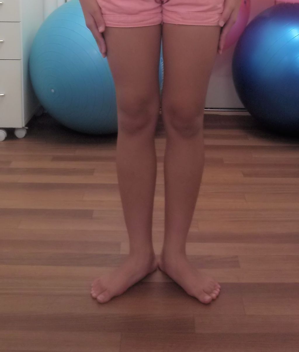 色々な足 55 バスケットをしている12歳の女子 やぶにらみ膝 反張膝 偏平足 いけちゃんのblog 練馬区関町の池島接骨院 院長日記 バレエ テーピング 足底板など