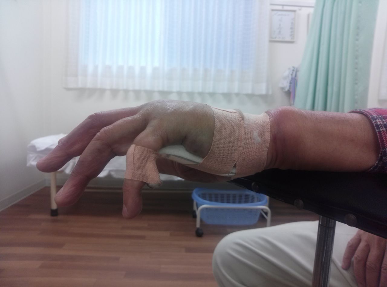 今日の桜と 第五中手骨骨折 いけちゃんのblog 練馬区関町の池島接骨院 院長日記 バレエ テーピング 足底板など