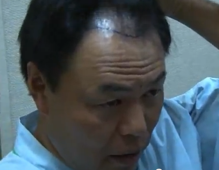 ギャオス内藤自毛植毛