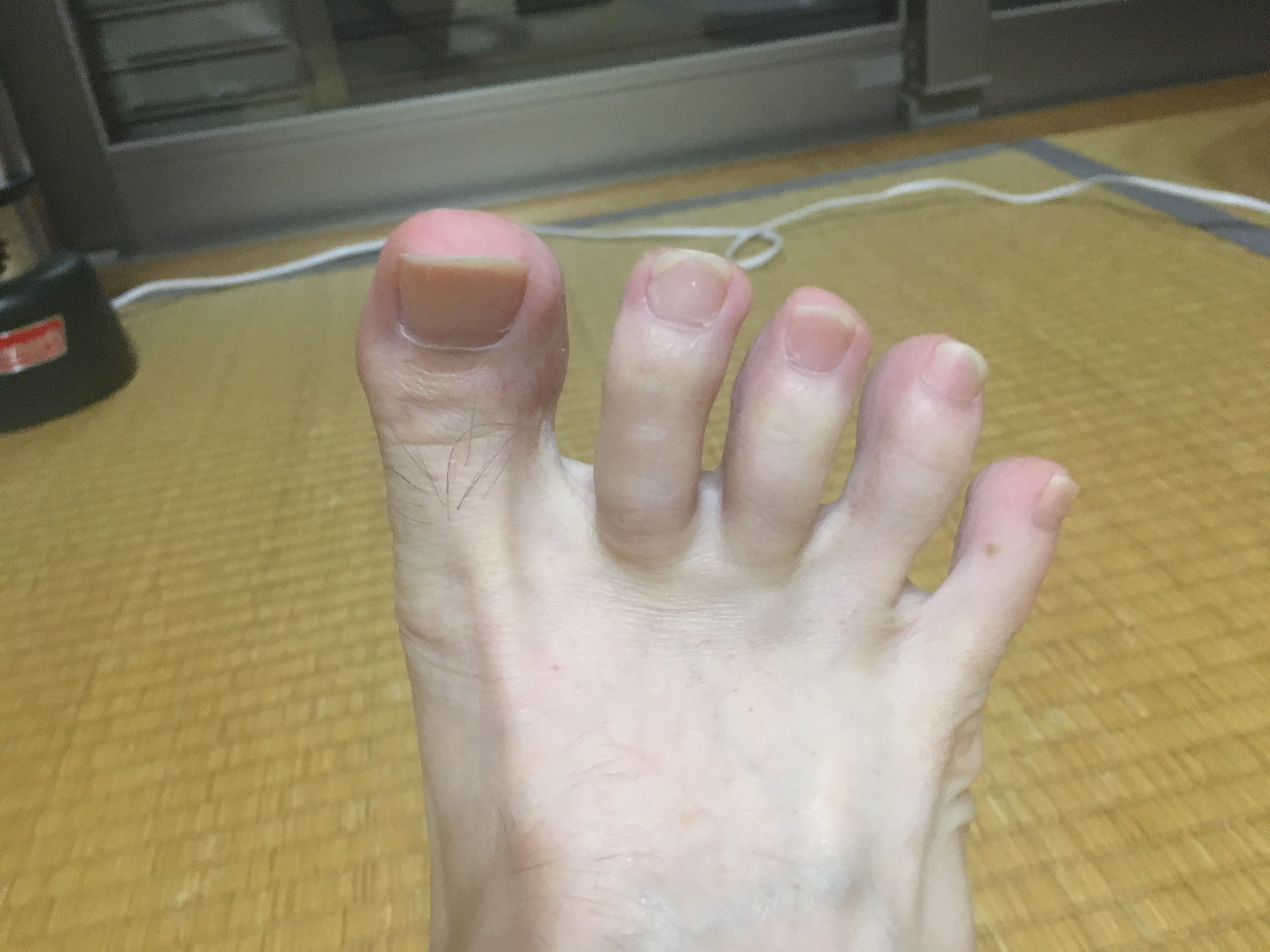 足根管症候群 手術後の経過 日々の生活 足根管症候群 手術後の経過 日々の生活