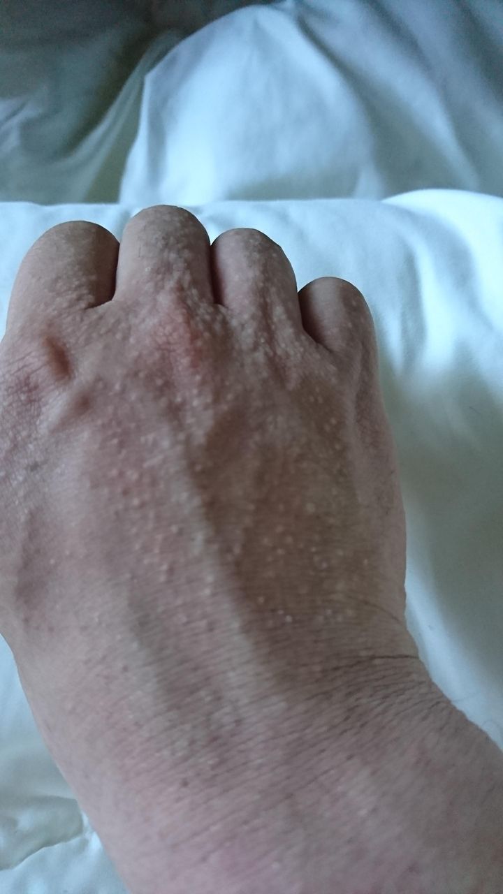 閲覧注意 お昼寝から起きたら手の甲にぶつぶつが出来てたんやが 今あなたの後ろに速報 閲覧注意 お昼寝から起きたら手の甲にぶつぶつが出来てたんやが 今あなたの後ろに速報