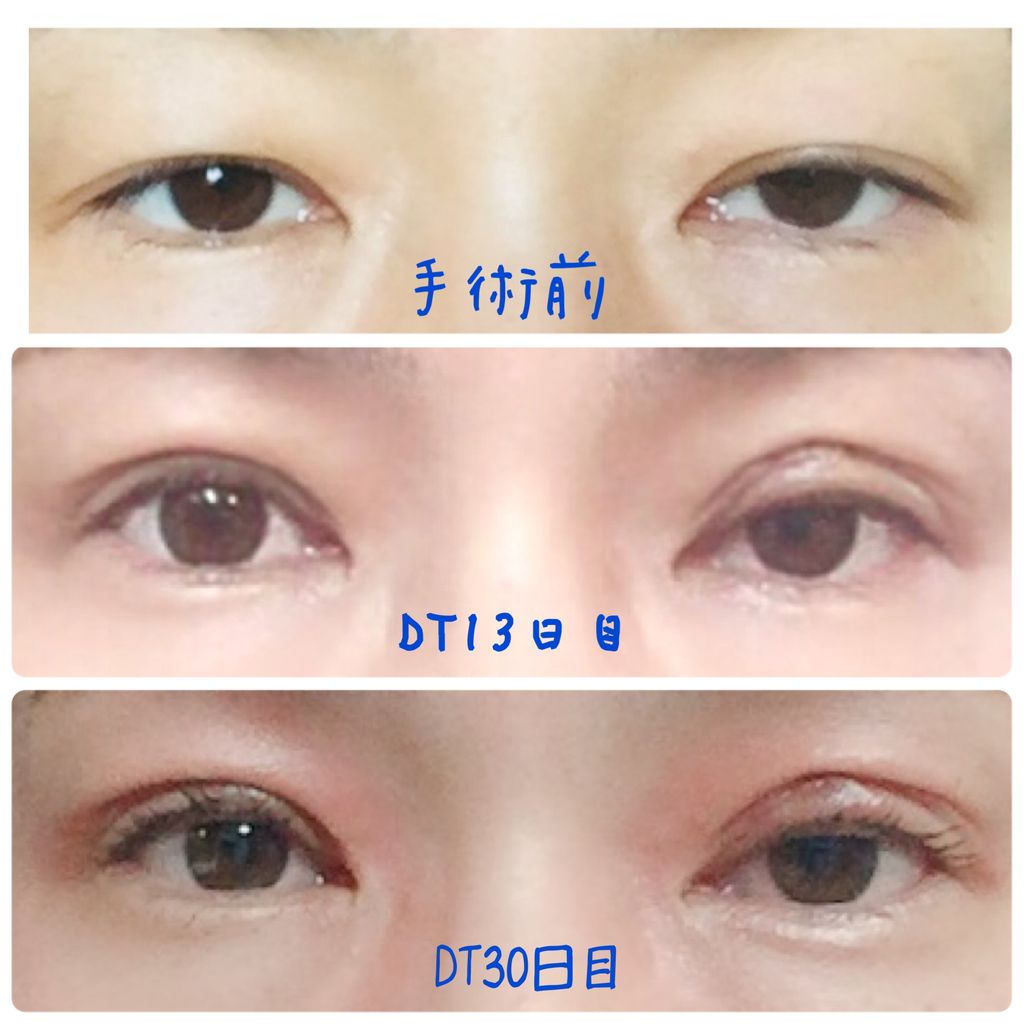 眼瞼下垂の手術 Dt30日目 1ヶ月 うなきちのハッピーライフ その2