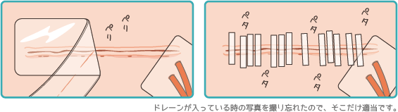 乳房全摘の創部