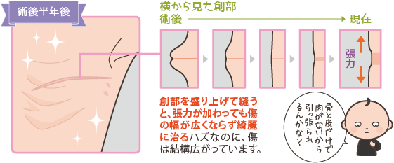 乳癌手術後の創部の変化