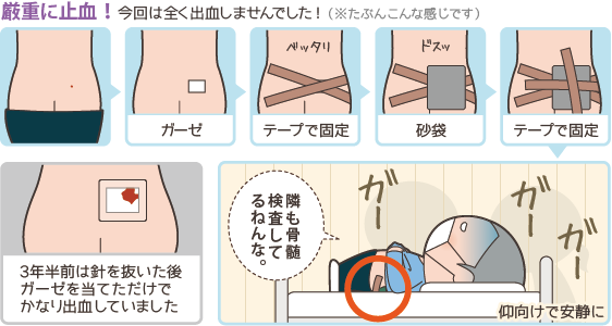 骨髄穿刺の止血