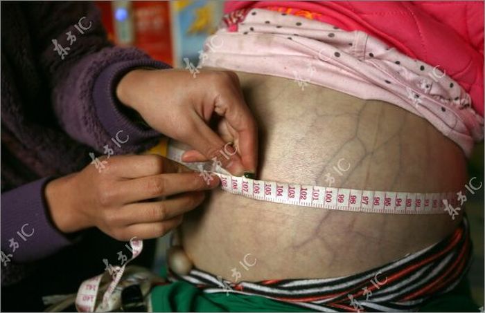 腹が膨れるという原因不明の病気を患っている女の子 インパクト野郎
