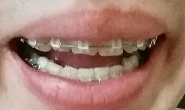 歯並び悪いやつは矯正しろ マジで世界変わるぞ 2chまとめ 読み物 長編 名作 2monkeys Jp