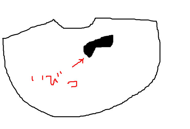 胞状奇胎が発覚するまでの症状 パネンの転勤族妻日記 胞状奇胎が発覚するまでの症状 パネンの転勤族妻日記