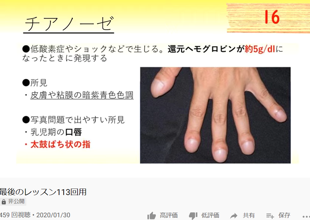 113回を覗くシリーズ２ ロムニー配信から抜粋 115回 歯科医師国家試験対策 必修 一般対策ならロムニーハウス勉強会