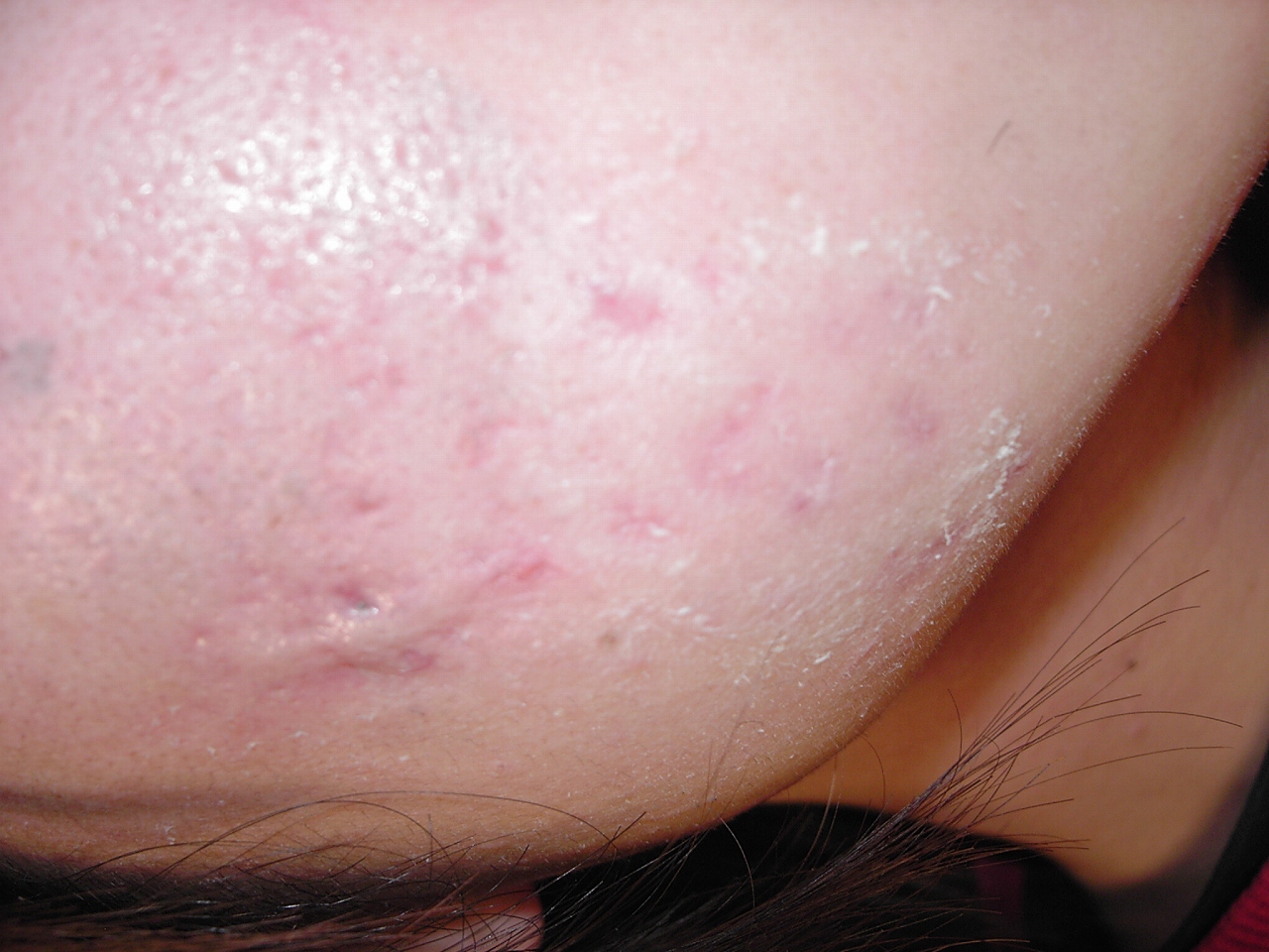 ニキビ 治る 時間帯 ニキビ 治る 時間帯