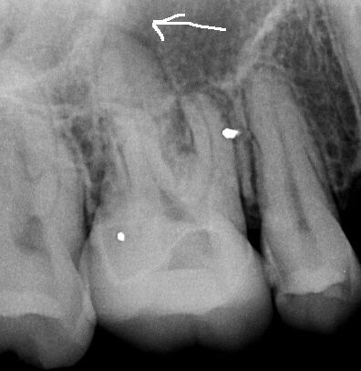レントゲンとctの見え方の違い 房総勝浦の磯野歯科医院 公式 ブログ