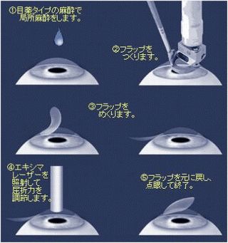 レーシック