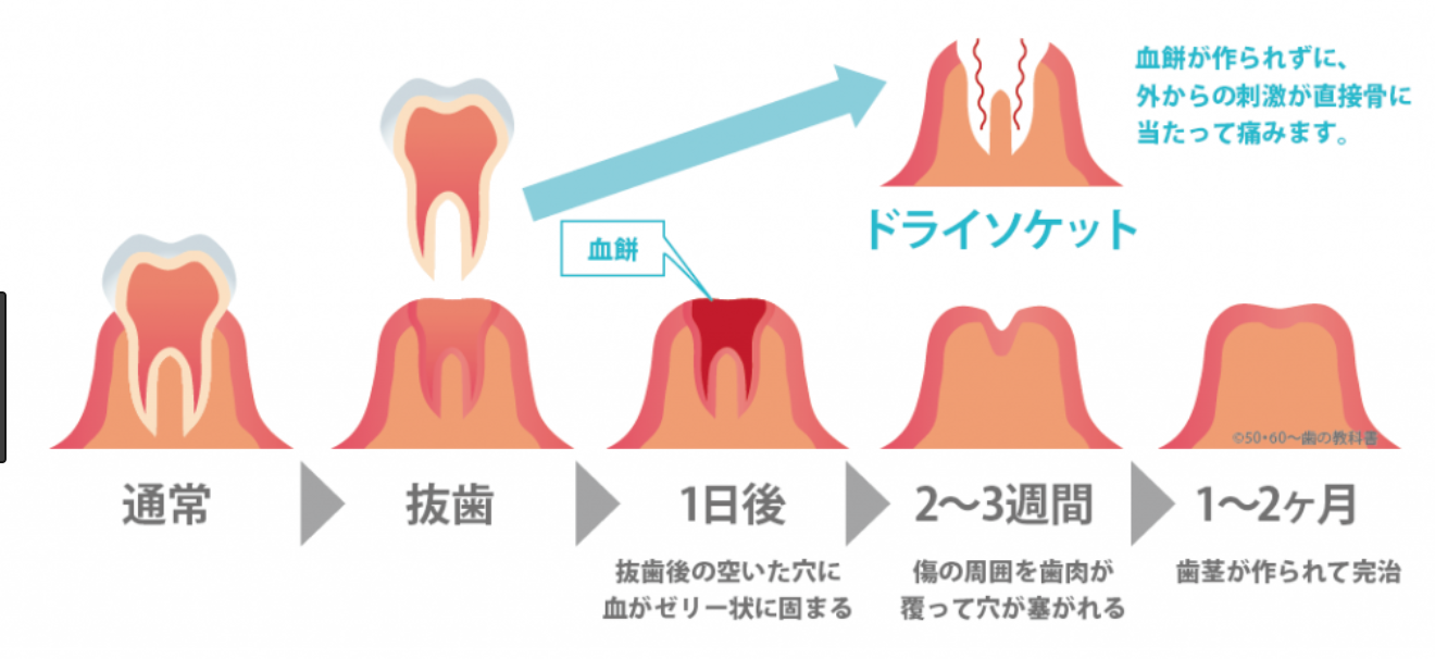 ソケット ドライ