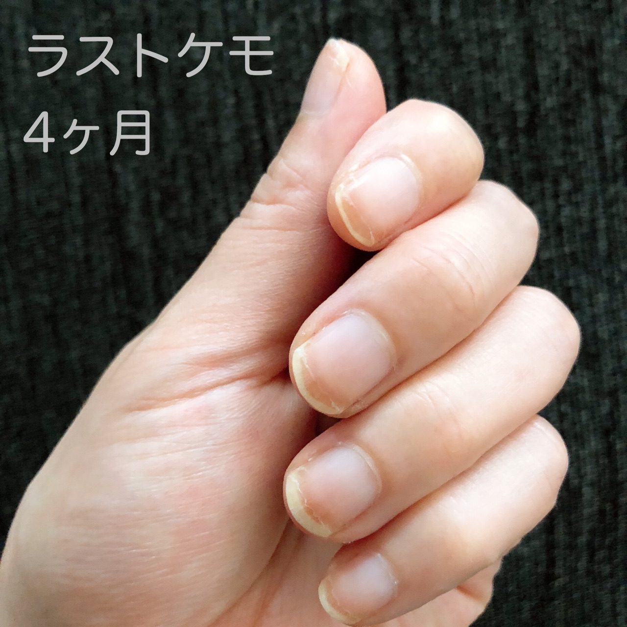 抗がん剤の副作用で変色してしまった爪のその後 Jamのおうち ごはんと器とインテリア Powered By ライブドアブログ