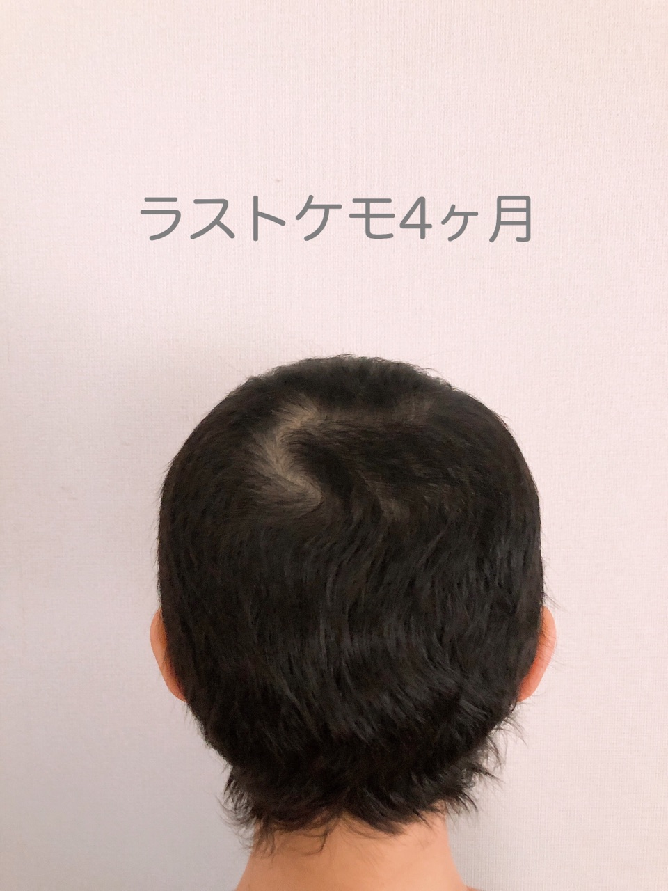 ラストケモ4ヶ月 現在の発毛状況 Jamのおうち ごはんと器とインテリア Powered By ライブドアブログ